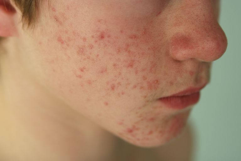 Los signos y síntomas comunes del acné