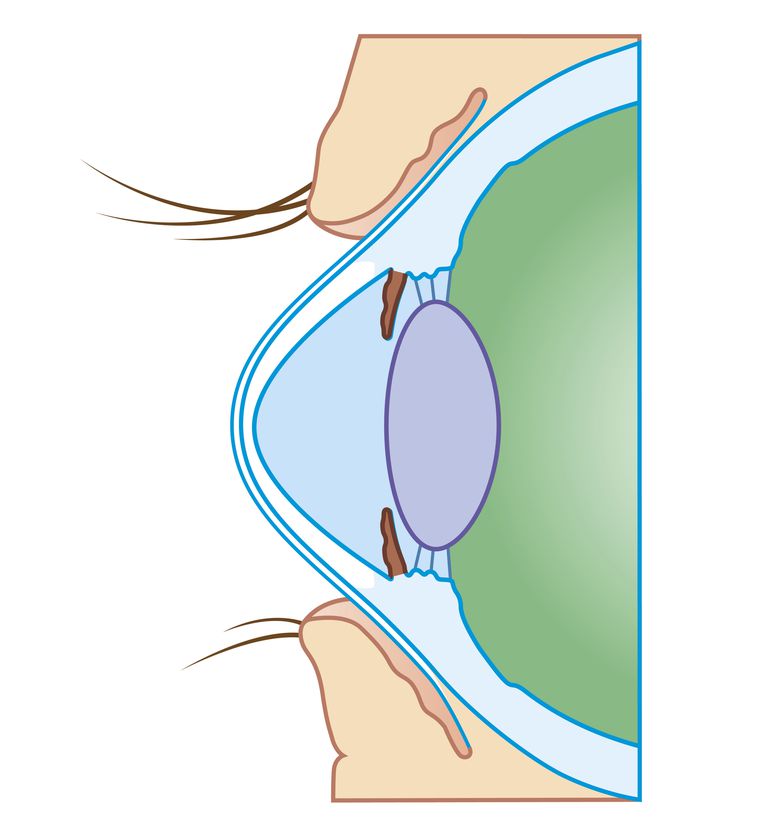 Salud ocular cross La reticulación de la córnea (CXL) es un tratamiento para las personas que sufren de una córnea que se vuelve inestable y débil. La córnea comienza a aumentar o sobresalir, causando visión borrosa y distorsionada, a veces impactando en gran medida la calidad de vida. La reticulación corneal es un método utilizado para retrasar la progresión de los cambios en la córnea. La reticulación corneal usa luz ultravioleta para fortalecer los enlaces químicos dentro de la córnea.