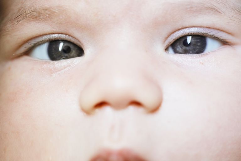 Ojos cruzados en el recién nacido