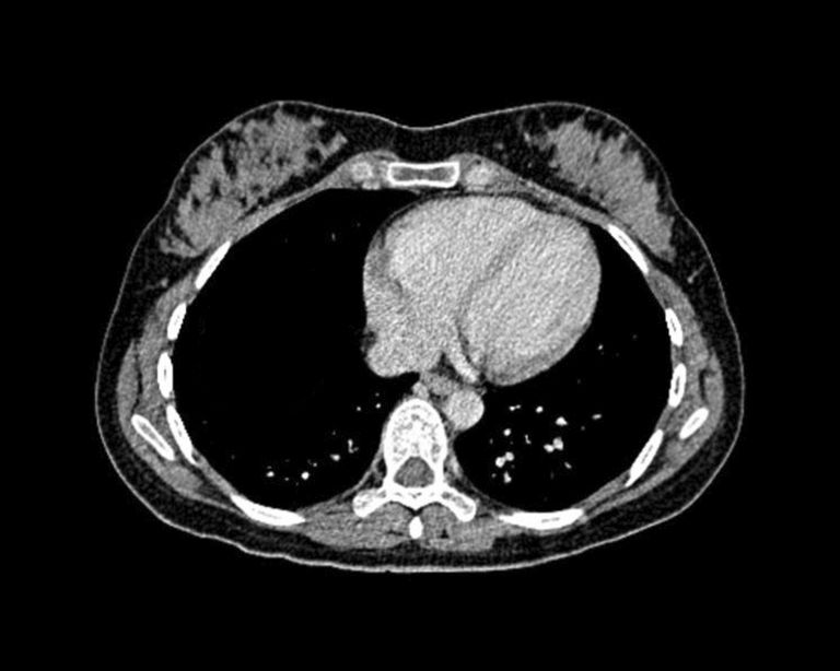 Examen de cáncer de pulmón CT