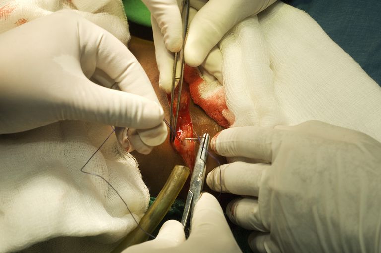 ¿Debería someterse a una cirugía para la Radiculopatía Cervical?