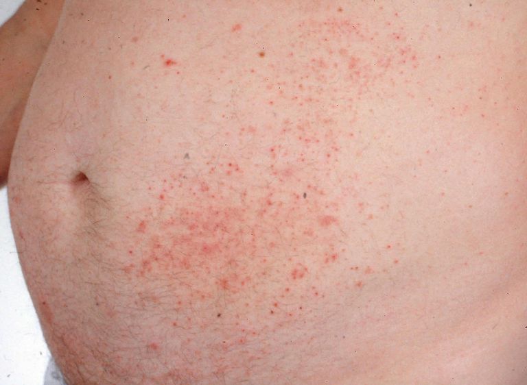 Dermatitis herpetiforme diagnosticada con biopsia de la piel
