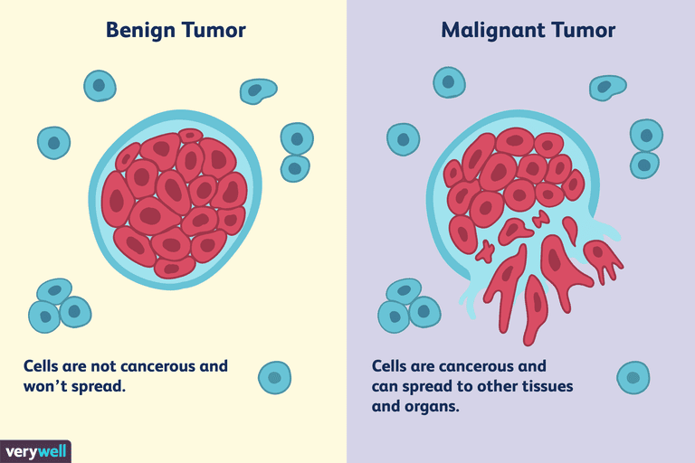 Diferencias entre un tumor maligno y benigno