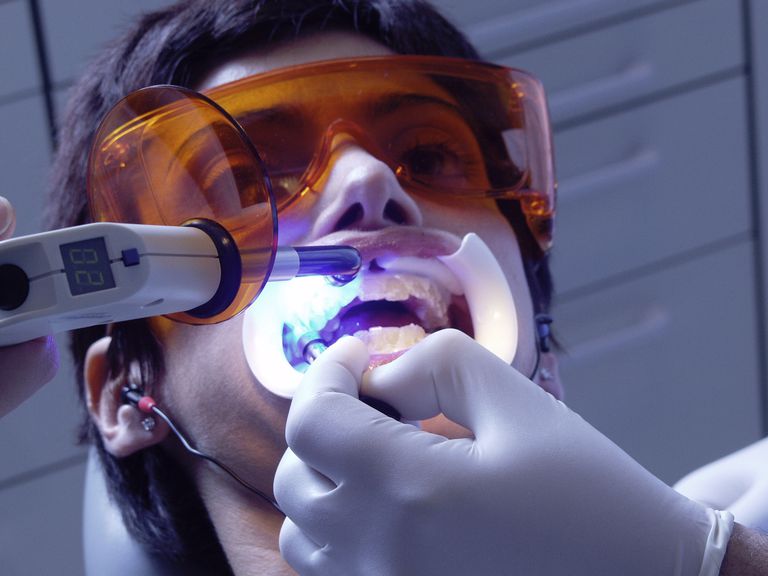 Diferentes métodos para blanquear los dientes