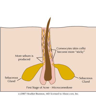 Diferentes tipos de acné