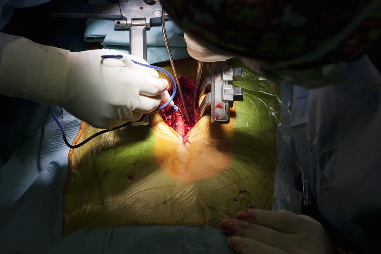 Rasgaduras del saco dural durante la cirugía de la columna