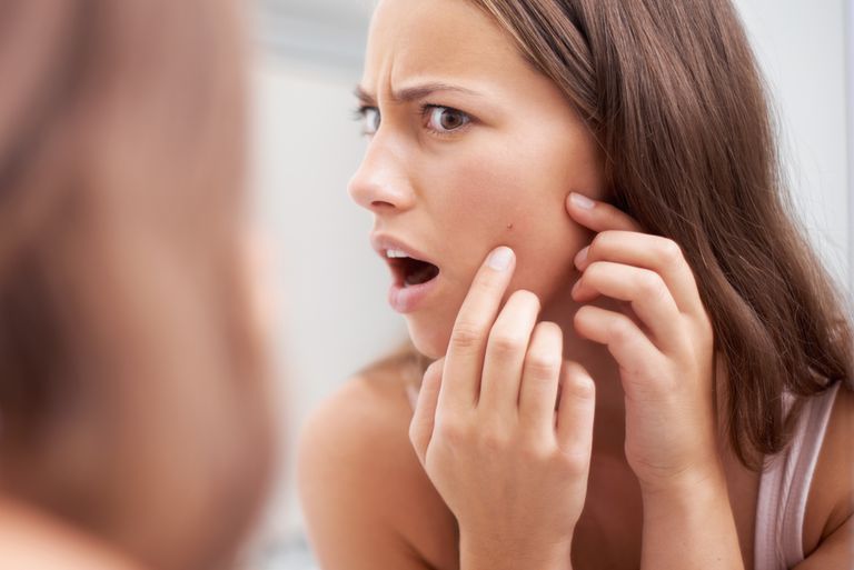 Experiencias con el acné como efecto secundario de Solu-Medrol