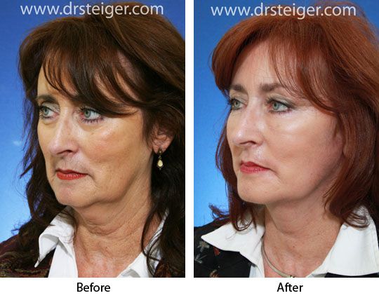 Fotos de antes y después de cirugía estética