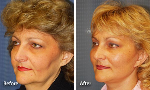 Fotos de antes y después de cirugía estética
