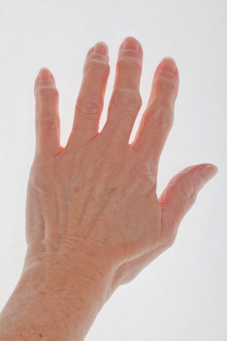 Artritis del dedo