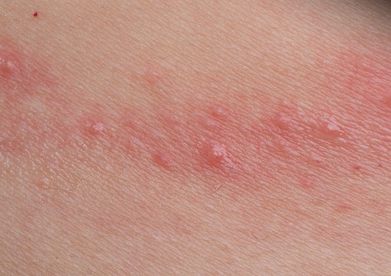 Una guía sobre las causas comunes de la dermatitis de contacto