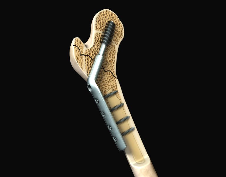 Extracción de hardware: la cirugía ortopédica más difícil