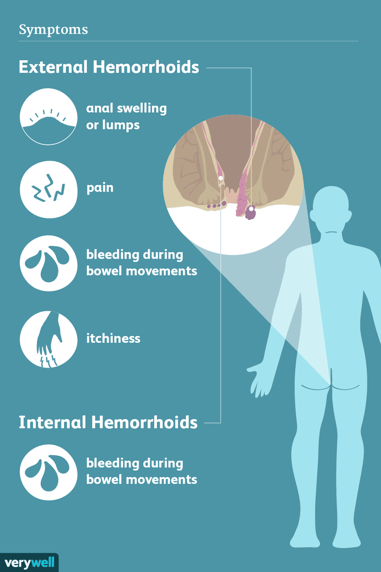 Hemorroides: signos, síntomas y complicaciones
