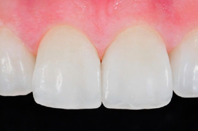 ¿Cómo se instalan las carillas dentales?
