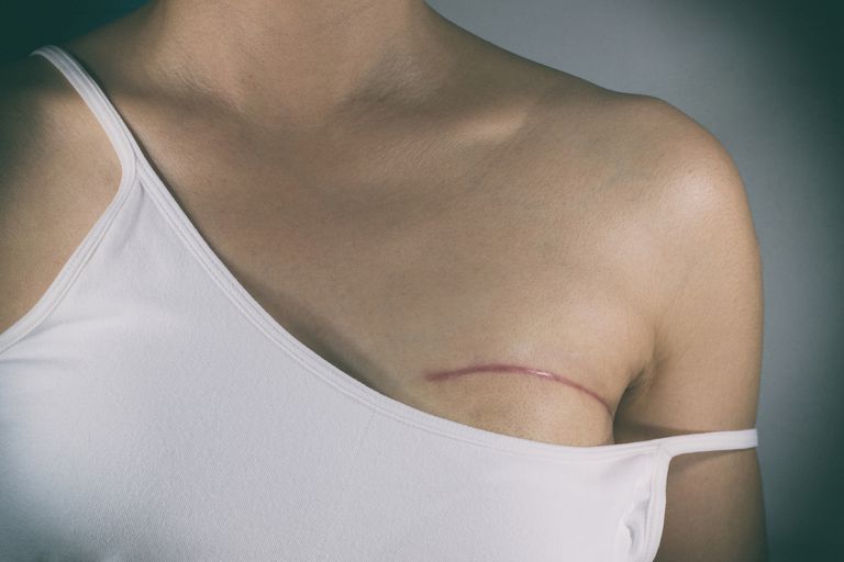 Cómo el cáncer de mama puede afectar su imagen corporal