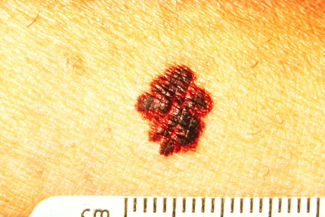¿Cómo se puede saber si se trata de un topo o cáncer de piel?