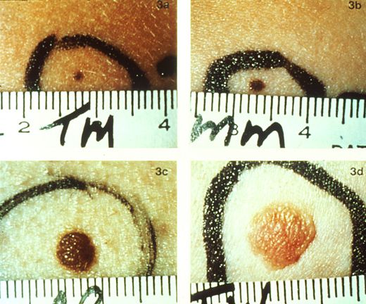 ¿Cómo se puede saber si se trata de un topo o cáncer de piel?