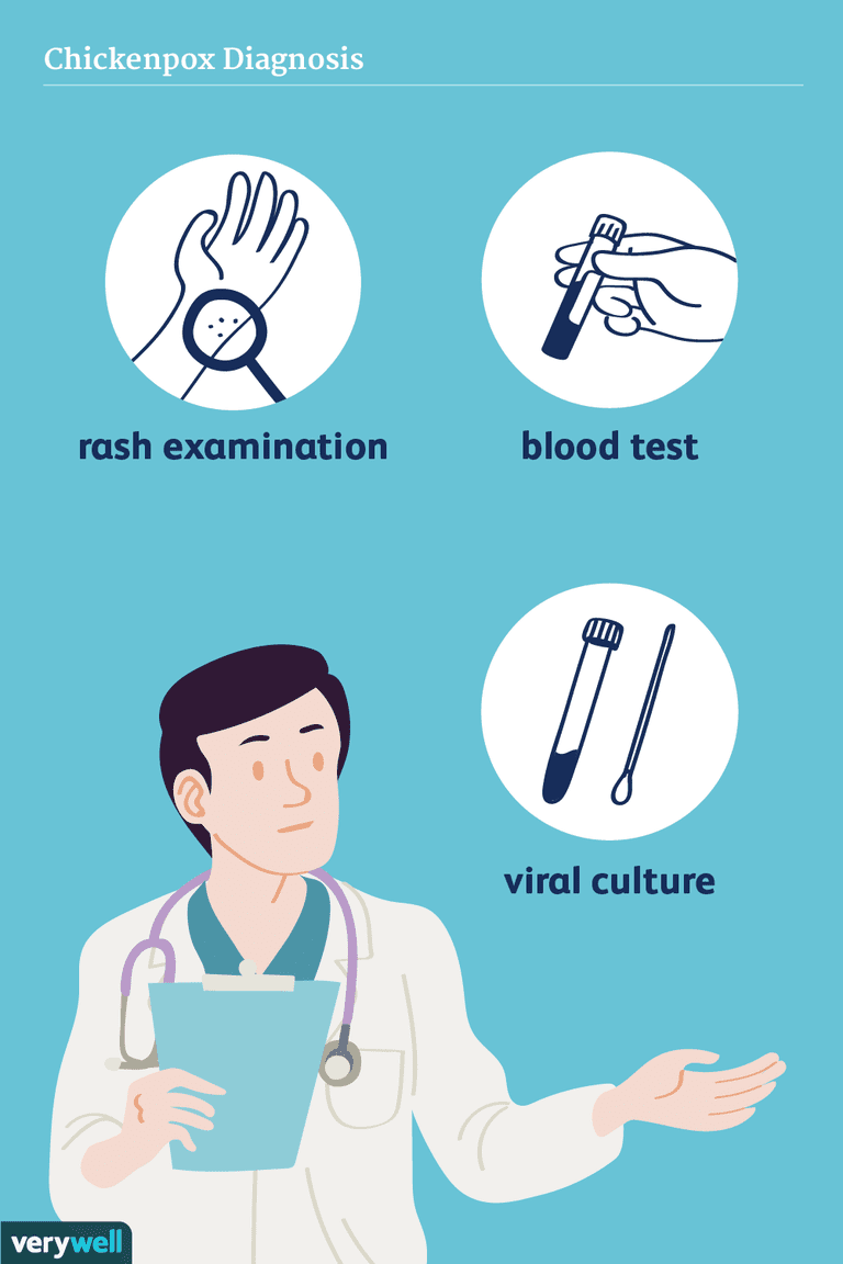 Cómo se diagnostica la varicela