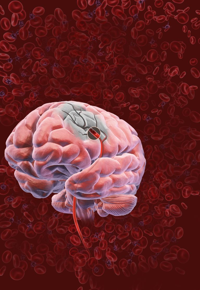 ¿Cómo un accidente cerebrovascular causa daño cerebral?