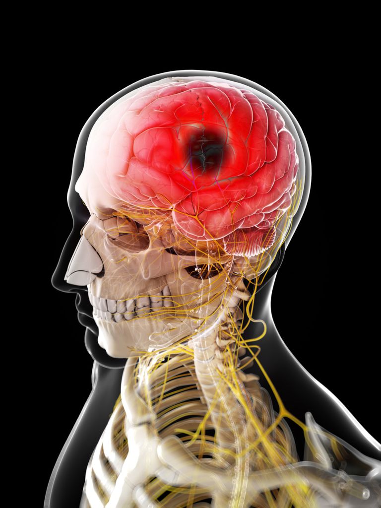 Cómo un dolor de cabeza puede ser un signo de un derrame cerebral