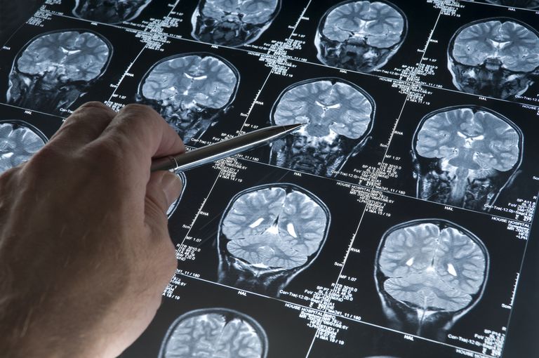 ¿Cómo se diagnostica la enfermedad de Alzheimer?