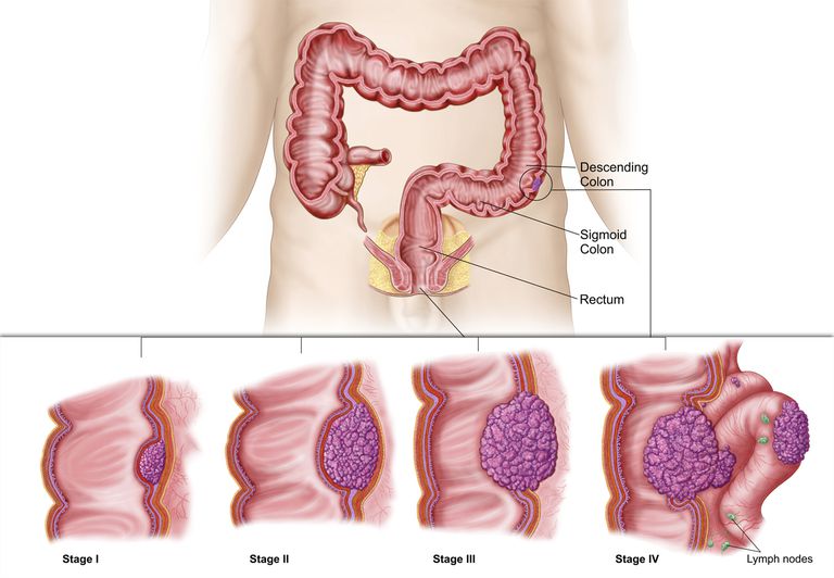 ¿Cómo se determina el estadio del cáncer de colon?