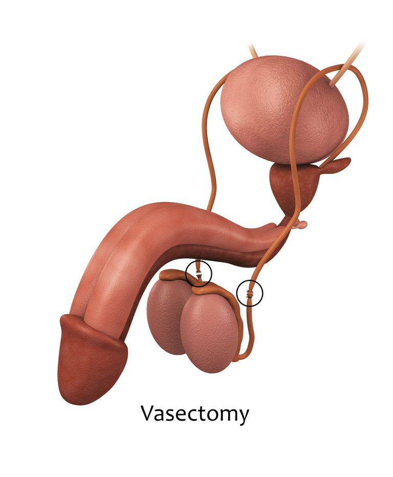 ¿Cómo se realiza una vasectomía?