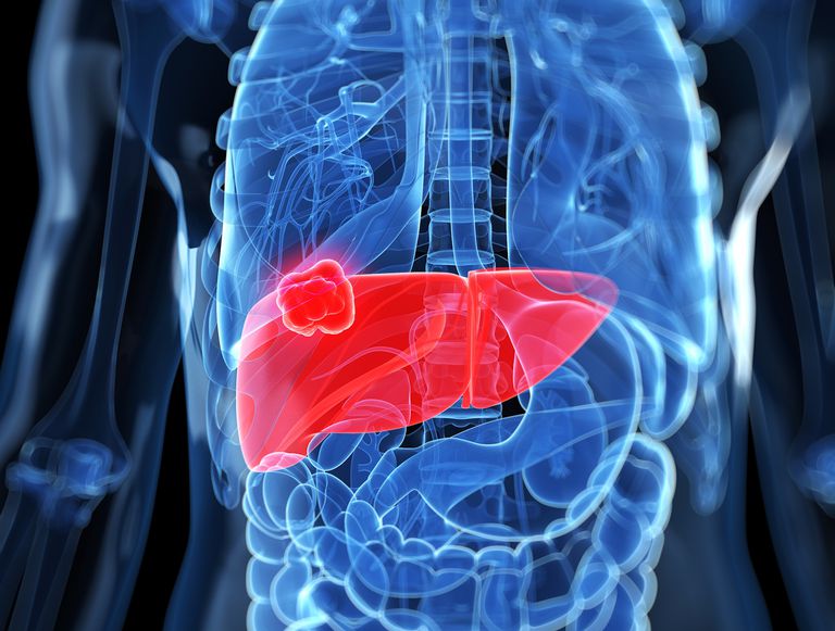 Cómo se propaga el cáncer de pulmón al hígado