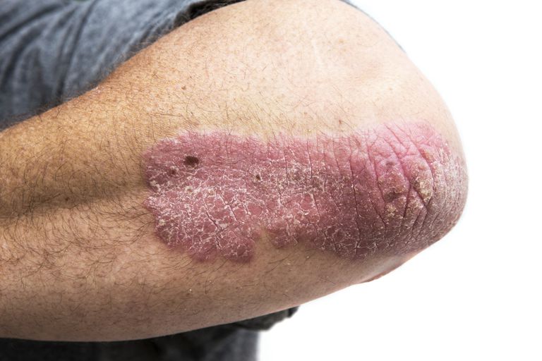 Cómo afecta el lupus a la piel