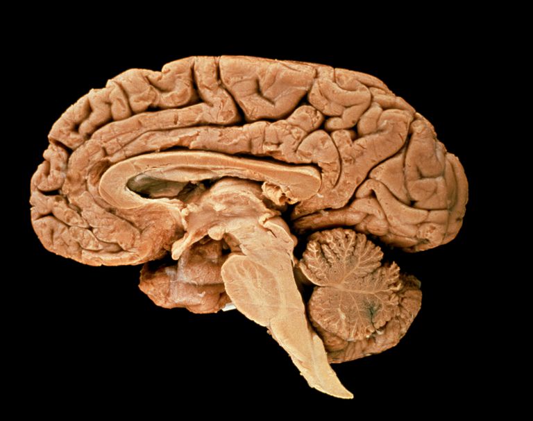 Cómo la EM afecta el tallo cerebral
