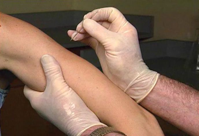 Cómo las vacunas de la viruela ayudaron a ganar la revolución estadounidense