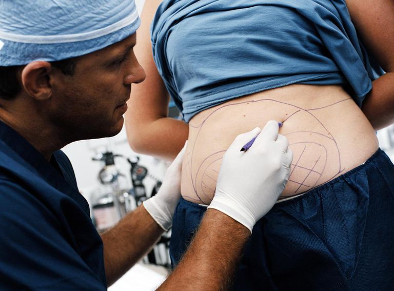 Cómo cuidar su abdominoplastia después de la cirugía