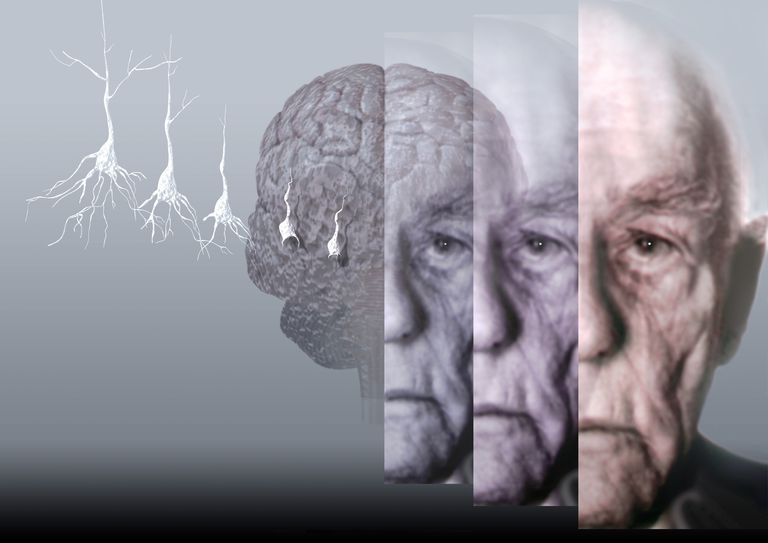 Cómo manejar comportamientos desafiantes en el Alzheimer