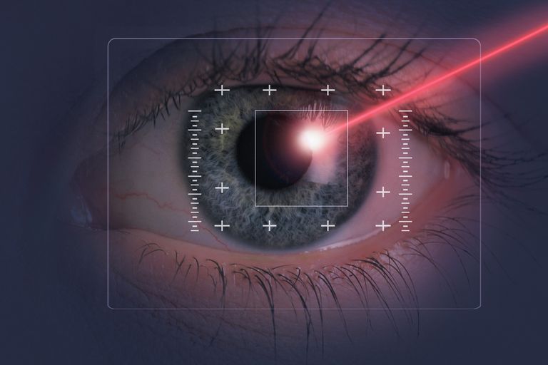 Cómo prepararse para la cirugía ocular LASIK