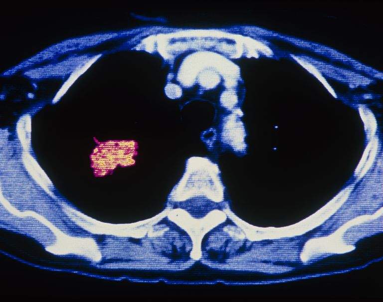 Datos importantes sobre el cáncer de pulmón