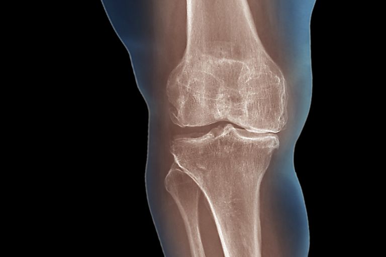 ¿Se necesita una resonancia magnética para diagnosticar la osteoartritis?