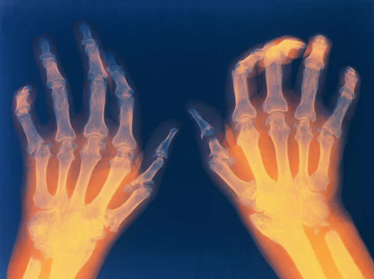 ¿El tratamiento temprano y agresivo es mejor para todos los pacientes con artritis reumatoide?