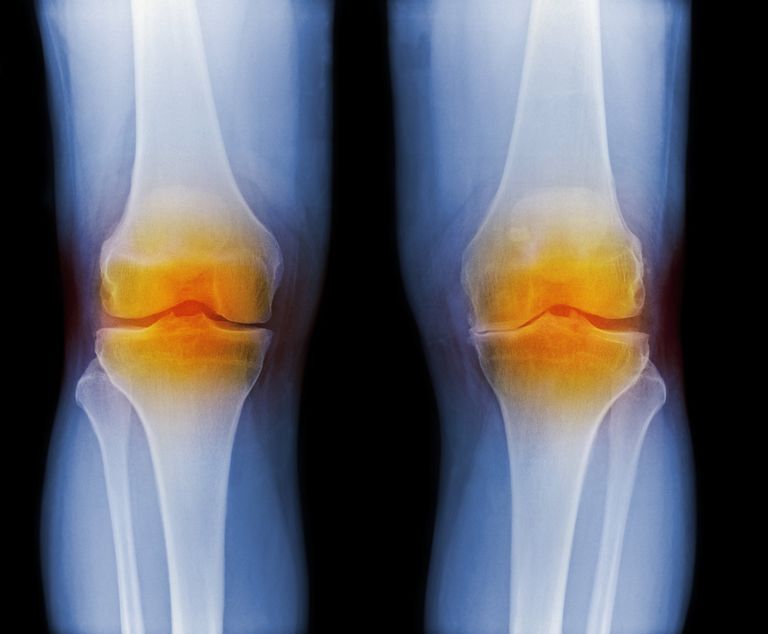 Daño articular en la artritis reumatoide y la osteoartritis