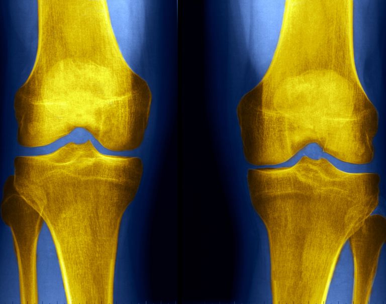 Rayos X de la rodilla y detección de anormalidades