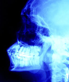 Aprenda sobre radiografías dentales y cáncer de tiroides