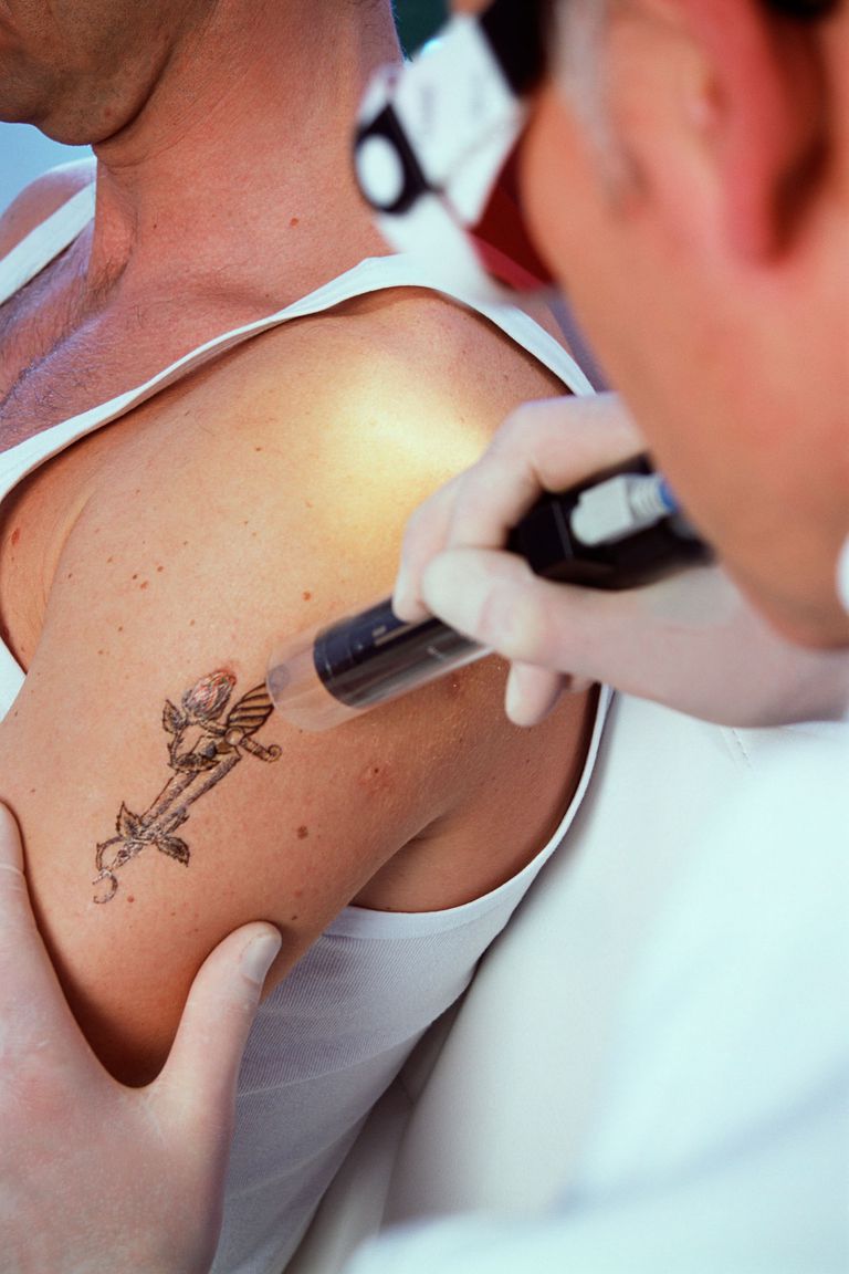 Aprenda sobre la eliminación de tatuajes con láser