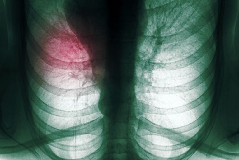 Lobectomía como tratamiento para el cáncer de pulmón