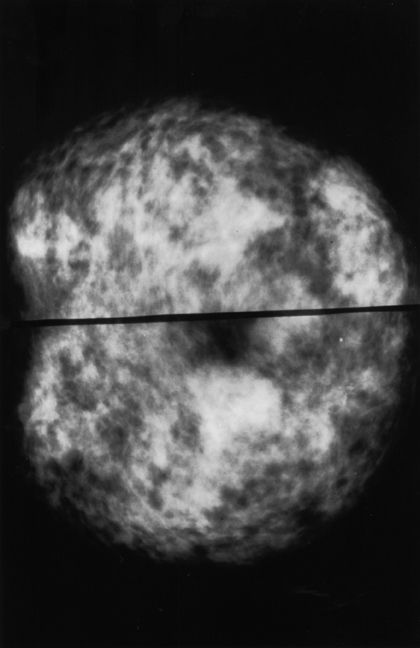 Imágenes de mamogramas Normal y anormal
