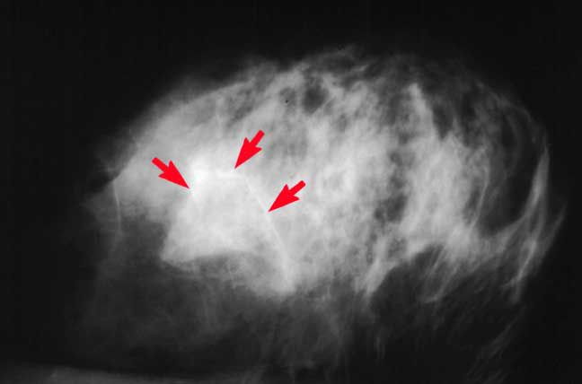 Imágenes de mamogramas Normal y anormal