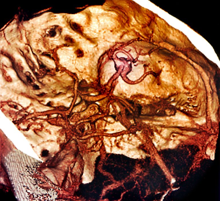 Arteria Cerebral Media (ACM)