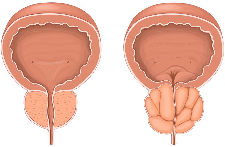 Una opción más amigable para el paciente para tratar las próstatas agrandadas
