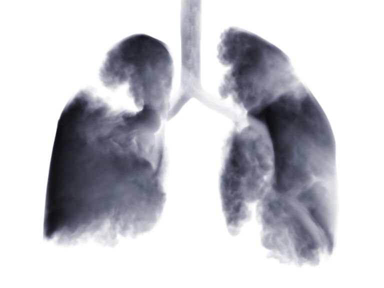 Tipo más común de cáncer de pulmón