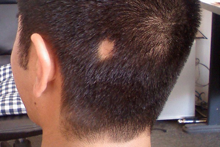 Tratamientos Naturales para la Alopecia Areata