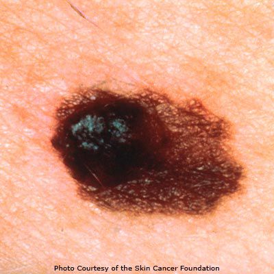 Mole normal versus melanoma: qué buscar en un autoexamen