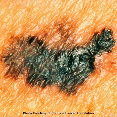Mole normal versus melanoma: qué buscar en un autoexamen